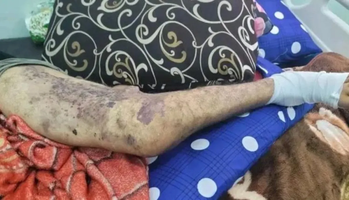 زيارة تكشف تفاصيل صادمة | نداء استغاثة من سجين يعاني من مرض نادر في تعز  : أفرجوا عني قبل فوات الأوان