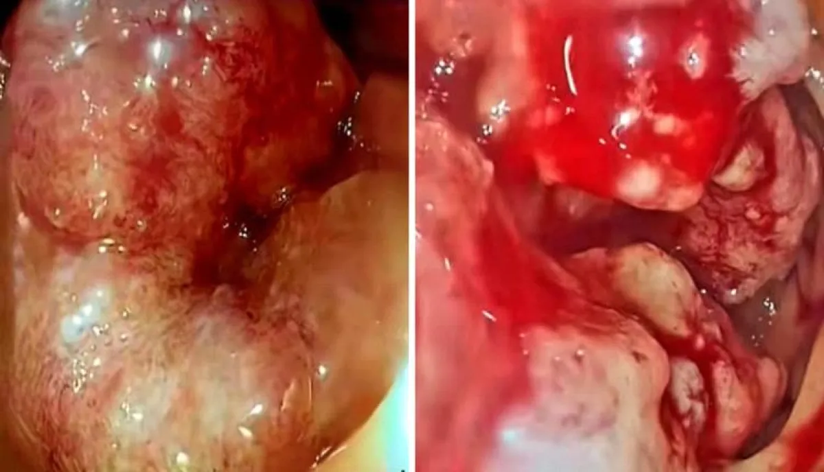 تفاصيل صادمة | قصة مؤلمة تهز صنعاء.. طبيب يروي مأساة فتاة ظنت المرض بسيطا فخطفها السرطان قبل زفافها