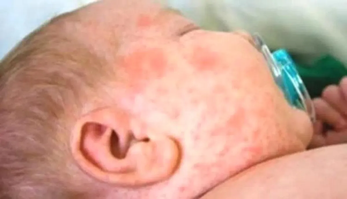 في حضرموت.. الحصبة يعاود الانتشار  بالمحافظة رغم خملات التطعيم