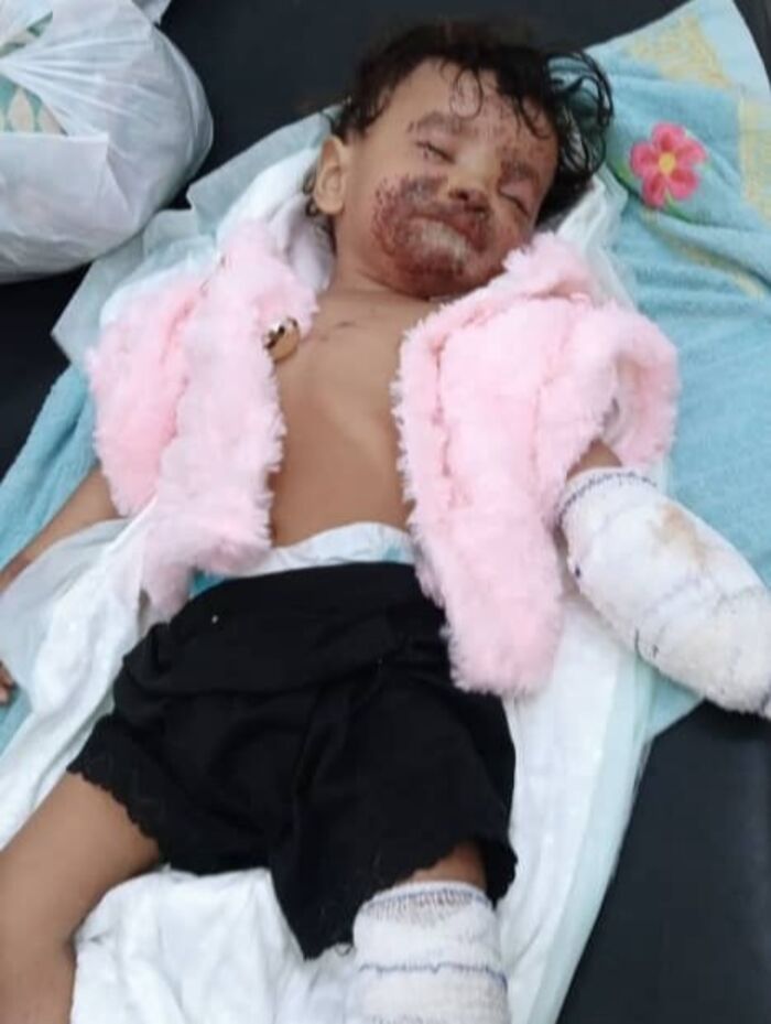 شاهد | مريم... زهرة الطفولة التي غدرها لغمٌ حوثي أمام عتبة بيتها | صوت الطفولة حين تنكسر وصوت اللعب حين يُفخّخ