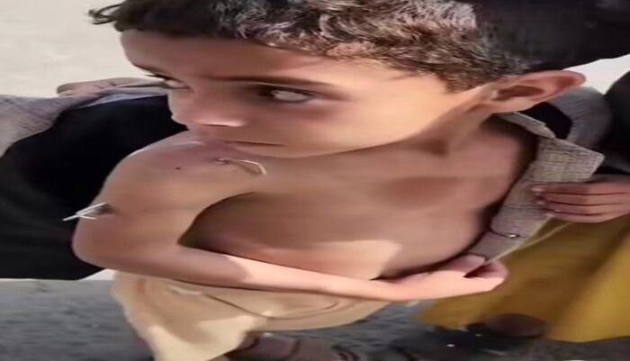 يحدث في صنعاء | عاد للمنزل وسيخ بجسده.. مستشفى يرفض علاج طفل مصاب لعدم دفع 900 ريال سعودي